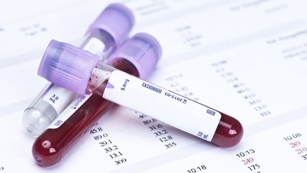 38663453 - hematology blood analysis report with lavender color blood sample collection tubes.