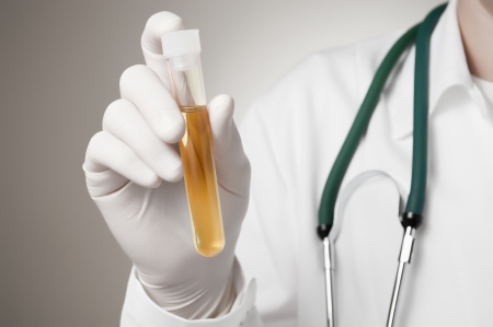 21991053 - doctor holding a bottle of urine sample